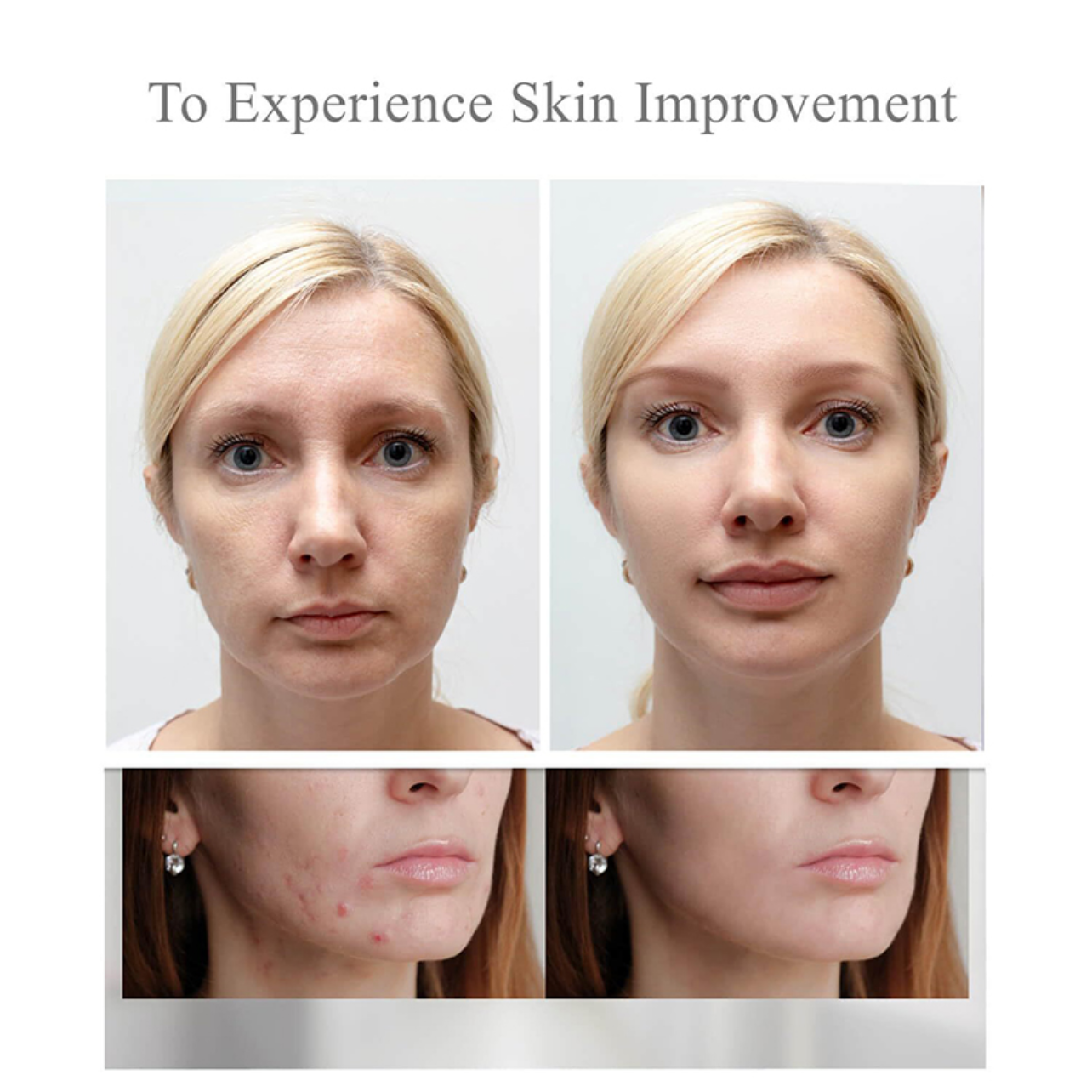 Before and after comparison of skin improvement with a person showing clear and blemished skin.